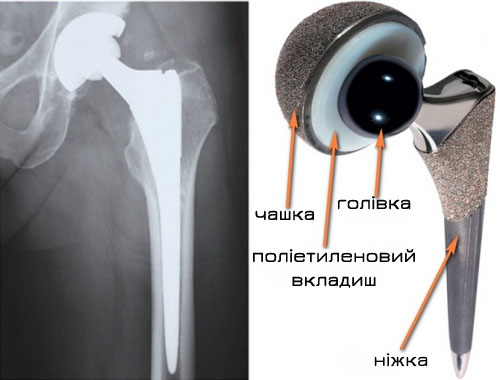 Реабілітація після ендопротезування кульшового суглоба