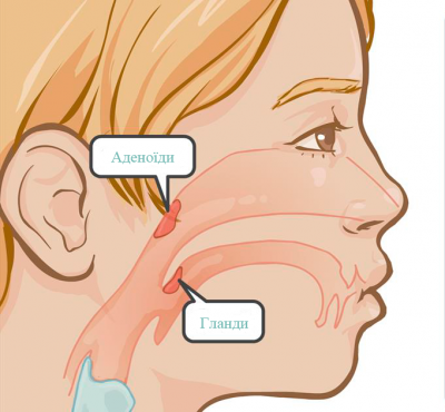 Кому потрібне видалення аденоїдів і як проходить операція?