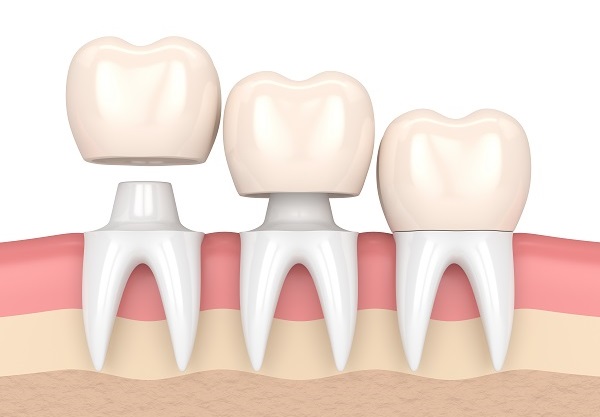 Коли потрібна зубна коронка? Огляд видів та їх особливостей