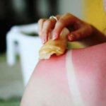 Сметана, олія та інші продукти, які не можна використовувати при сонячних опіках, щоб не погіршити ситуацію