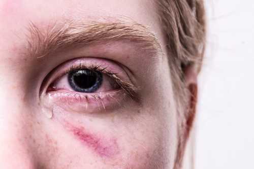 Причини, які викликають різь і біль в очах вранці після сну